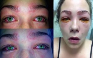 Reação alérgica causou queimaduras nas sobrancelhas e fez com que lágrimas e pus escorressem dos olhos da jovem
