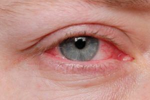 doencas oculares10