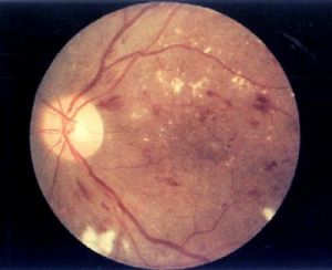Imagem de um exame de retinopatia diabética