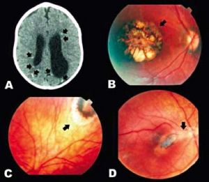 Ação da Toxoplasmose no globo ocular e na massa encefálica