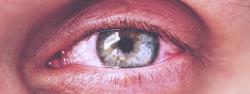 Conjuntivite e alergia ocular podem ser sintomas da Covid-19
