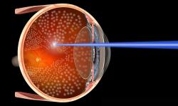 Fotocoagulação: laser para tratar os olhos Fotocoagulação: laser para tratar os olhos
