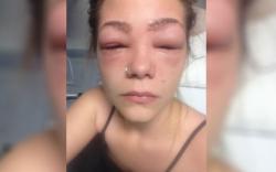 Após pintar as sobrancelhas e os cílios, jovem de 16 anos quase fica cega Após pintar as sobrancelhas e os cílios, jovem de 16 anos quase fica cega