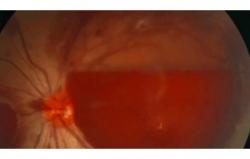 Mulher perde a visão de um olho após passar a noite no celular