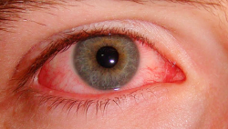 Saiba mais sobre Uveíte Saiba mais sobre Uveíte