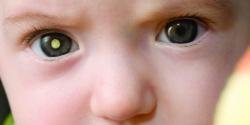 Retinoblastoma: tumor ocular em crianças Retinoblastoma: tumor ocular em crianças