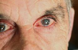 Conheça alguns sintomas iniciais da catarata, uma das principais causas de cegueira no mundo