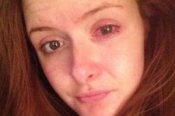 Jovem inglesa arranca a córnea ao usar lente por 10 horas Jovem inglesa arranca a córnea ao usar lente por 10 horas