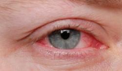 Estudo associa doenças oculares e depressão Estudo associa doenças oculares e depressão