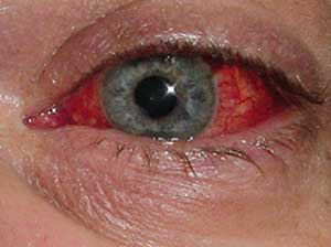 A auto-medicação pode apresentar risco para a saúde dos olhos
